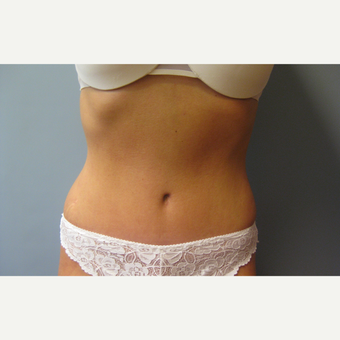 39 year old woman treated with Tummy Tuck and Liposuction after 3108172