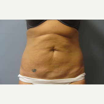 39 year old woman treated with Tummy Tuck and Liposuction before 3108172