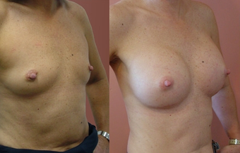 Breast Implants before 974263