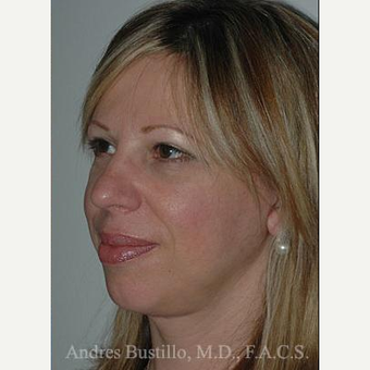 48 year old woman treated with Facelift after 3486283
