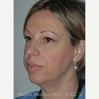 48 year old woman treated with Facelift before 3486283