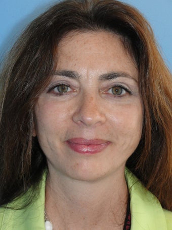 50 year old female treated for aging face 903199