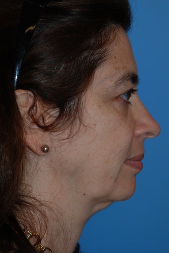 50 year old female treated for aging face before 903199