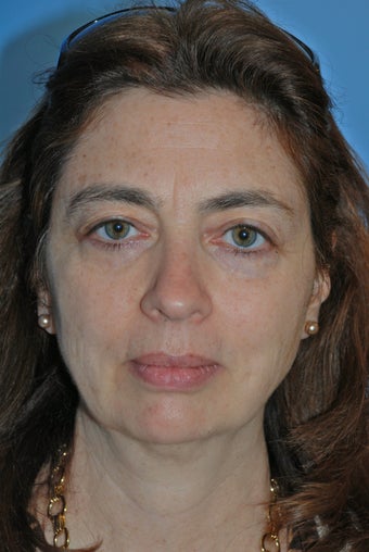 50 year old female treated for aging face 903199