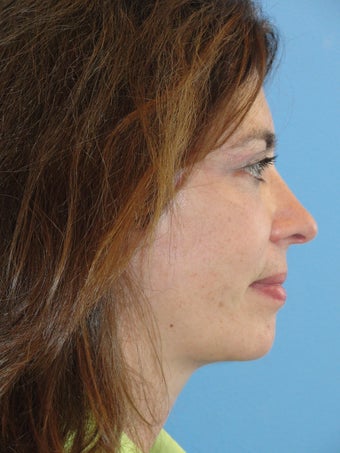 50 year old female treated for aging face after 903199