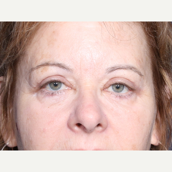 55-64 year old woman treated with Eyelid Surgery (view 1 of 2) after 3180530