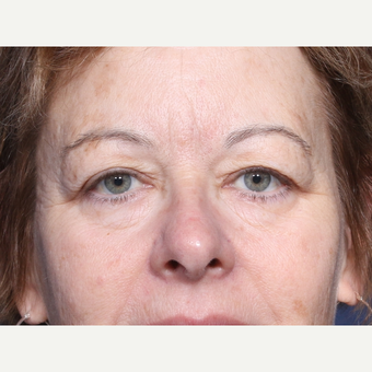 55-64 year old woman treated with Eyelid Surgery (view 1 of 2) before 3180530