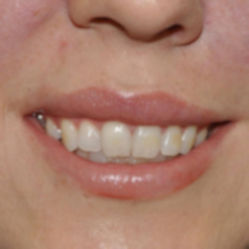 18-24 year old woman treated with Gum Lift after 3007549
