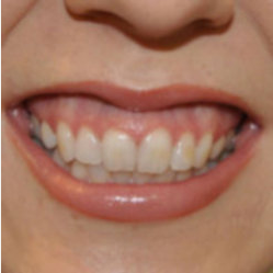18-24 year old woman treated with Gum Lift before 3007549