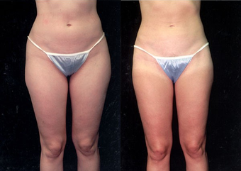 28-year-old woman treated with Liposuction. before 574524
