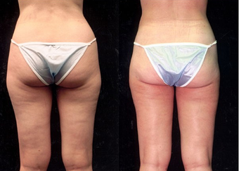 28-year-old woman treated with Liposuction. after 574524
