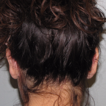 18-24 year old woman treated with Ear Surgery after 3140197