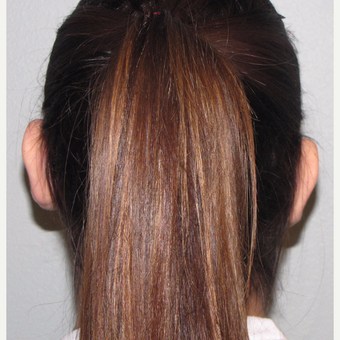 18-24 year old woman treated with Ear Surgery before 3140197
