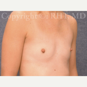 31 year old woman treated with saline Breast Implants before 2796995
