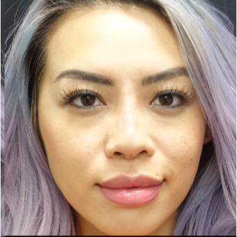 25-34 year old woman treated with Non Surgical Nose Job after 3152188