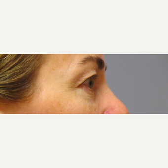 Eyelid Surgery before 3123641