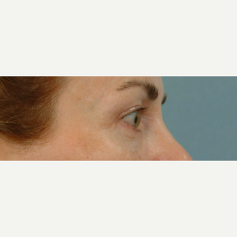 Eyelid Surgery after 3123641
