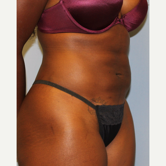 25-34 year old woman treated with Liposuction after 3564322