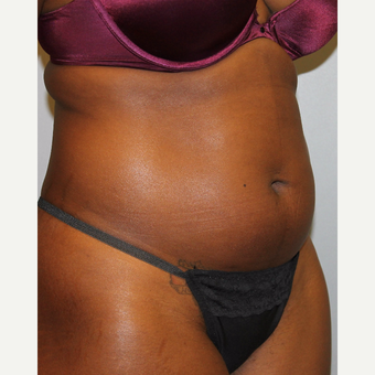 25-34 year old woman treated with Liposuction before 3564322