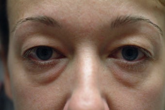 41 year old women with excess upper eyelid skin and lower eyelid bags before 1323947