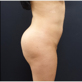 25-34 year old woman treated with Brazilian Butt Lift Revision before 3286177
