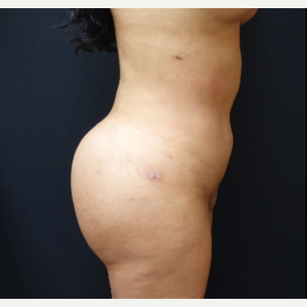 25-34 year old woman treated with Brazilian Butt Lift Revision after 3286177