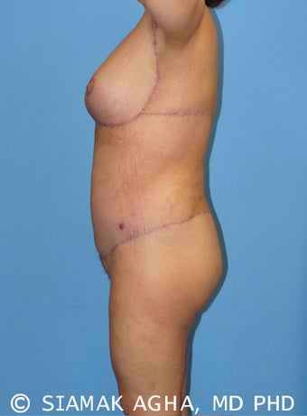 High-Definition™ Total Body Lift 177427