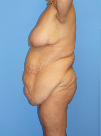 High-Definition™ Total Body Lift 177427