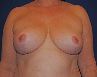 Breast Reduction after 402903