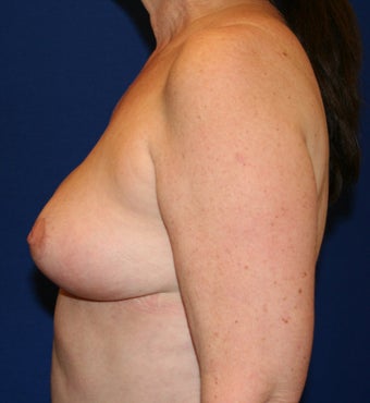 Breast Reduction 402903
