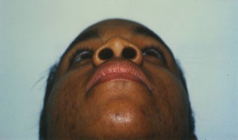 25-34 year old woman treated with African American Rhinoplasty before 2220245