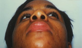 25-34 year old woman treated with African American Rhinoplasty after 2220245
