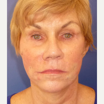 65-74 year old woman treated with Non Surgical Face Lift after 3691854