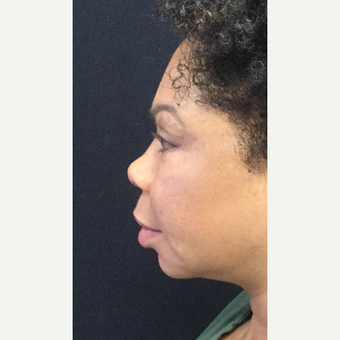 55-64 year old woman treated with Eyelid Surgery after 3218579