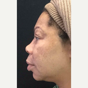 55-64 year old woman treated with Eyelid Surgery before 3218579