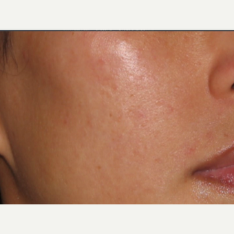 25-34 year old woman treated with Infini RF after 3725663