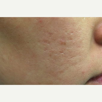 25-34 year old woman treated with Infini RF before 3725663