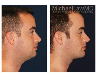 Chin Liposuction before 1341181