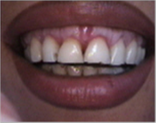 Smile make over, dental crowns, porcelain veneers, gummy smile before 1490459