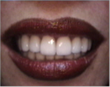 Smile make over, dental crowns, porcelain veneers, gummy smile after 1490459