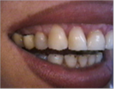 Smile make over, dental crowns, porcelain veneers, gummy smile 1490459
