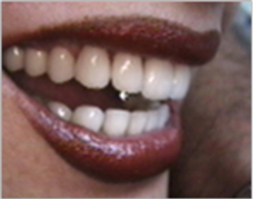 Smile make over, dental crowns, porcelain veneers, gummy smile 1490459