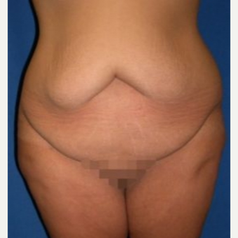 25-34 year old woman treated with Tummy Tuck before 3009713