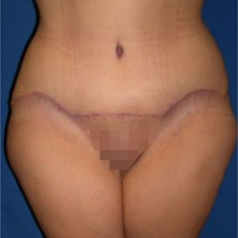 25-34 year old woman treated with Tummy Tuck after 3009713