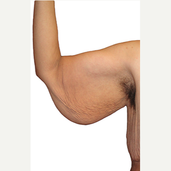 35-44 year old man treated with Arm Lift before 3409103