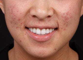 Laser Treatments for Red Acne Scarring before 1350519