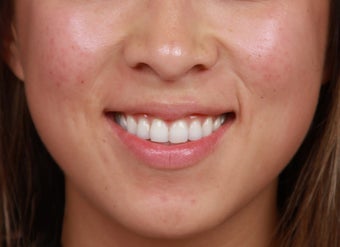 Laser Treatments for Red Acne Scarring after 1350519
