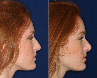 Nose Surgery before 1430626