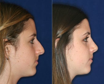 Nose Surgery before 1430629