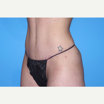 25-34 year old woman treated with Tummy Tuck after 3741580